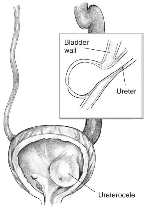 Ureterocele