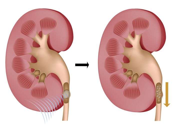 Extracorporeal shock wave lithotripsy treatment