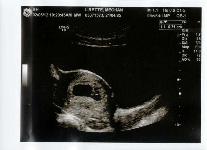 how accurate is dating ultrasound at 7 weeks