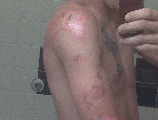 left shoulder