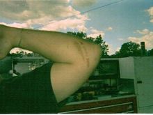 See? I told ya I burned it... That's what a hot, Wilwood 6-piston brake caliper will do to your elbow. That's 6 weeks after it happened...