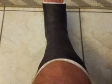 Plate,pins,screws,tendon and ligament reattachment. SUCKS! Biketoberfest...and grounded.   😯