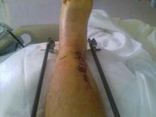 Leg stabilized after accident August 16, 2009.