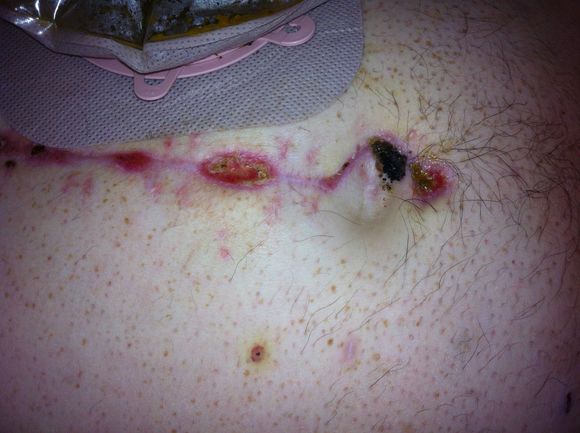 Day after the external fixators came out.