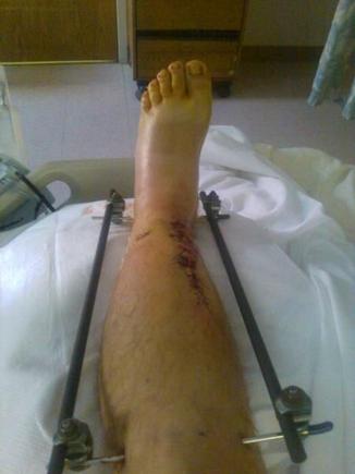 Leg stabilized after accident August 16, 2009.