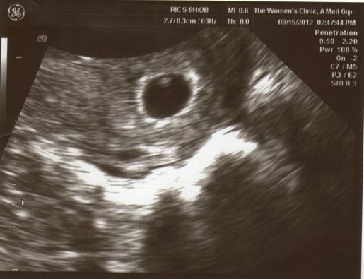 6-7 week scan picture gender guesses - JustMommies Message ...