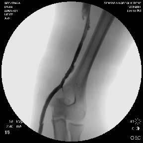 post-pta-fistulogram.jpg