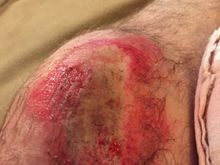 Sorry if this pic offends. Wanted to show the damage...