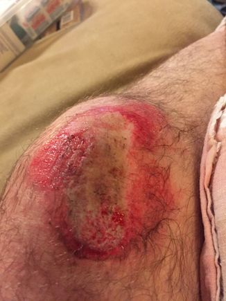 Sorry if this pic offends. Wanted to show the damage...